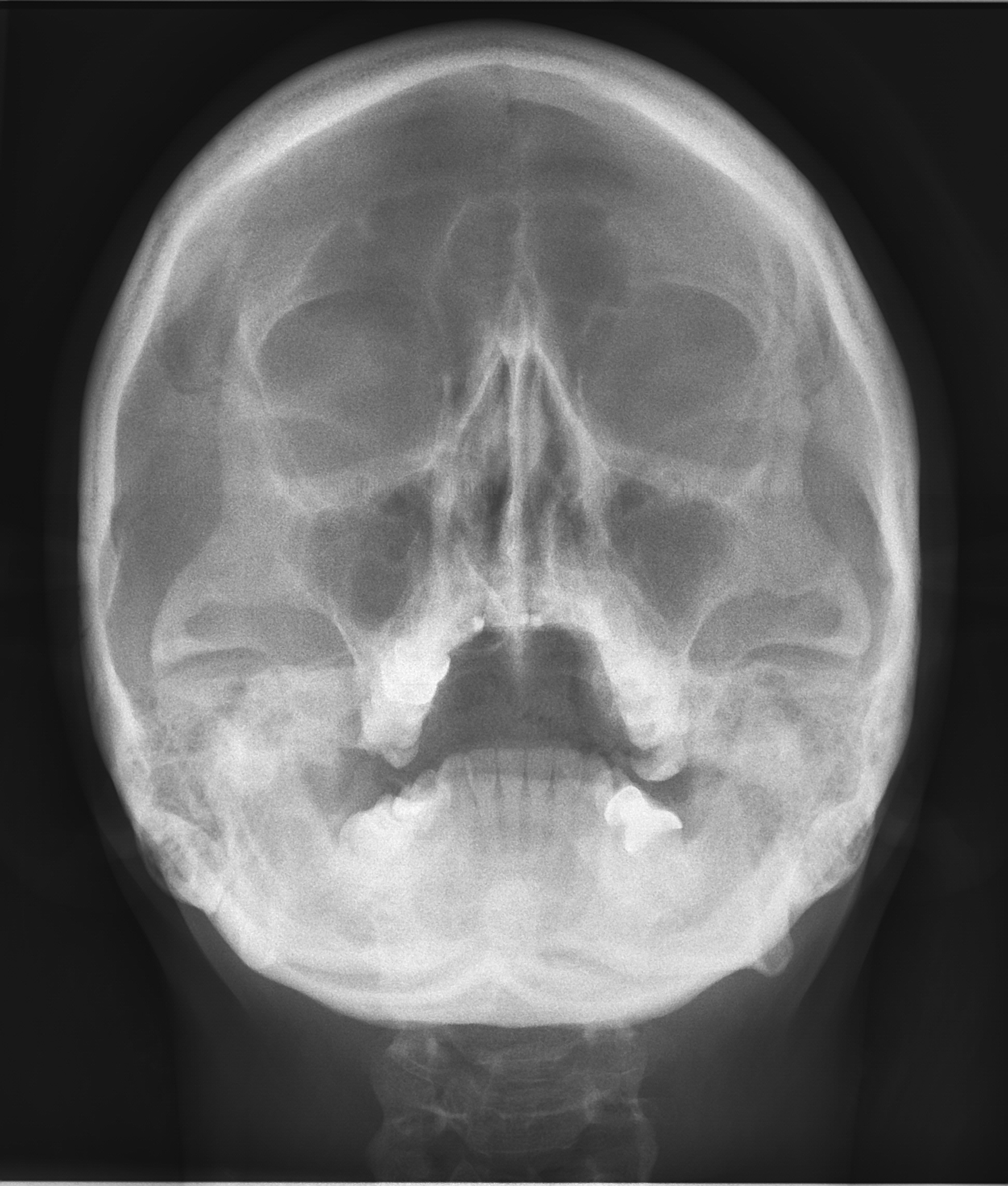 Medicina Rengen МДЛ-3В-Рентген